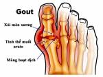 Nguyên nhân bệnh Gout