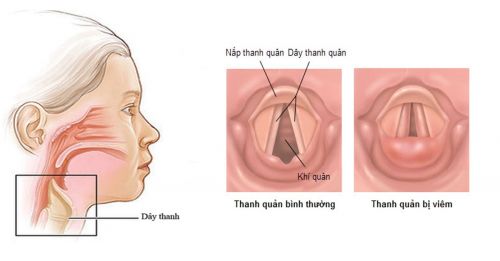 Đông y điều trị mất tiếng, khản tiếng