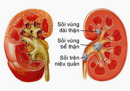 Bài thuốc thảo dược trị sỏi thận