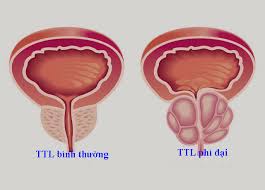 Bài thuốc trị U xơ tuyến tiền liệt
