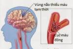 Cách phòng ngừa tai biến mạch máu não (Đột quỵ)