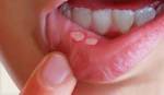 Bài thuốc dân gian trị viêm loét miệng (nhiệt miệng)