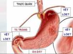 Bài thuốc thảo dược trị đau dạ dày mạn